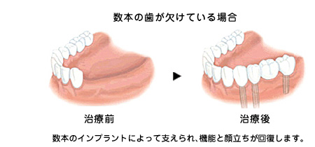 にしかわ歯科・ホワイトニング